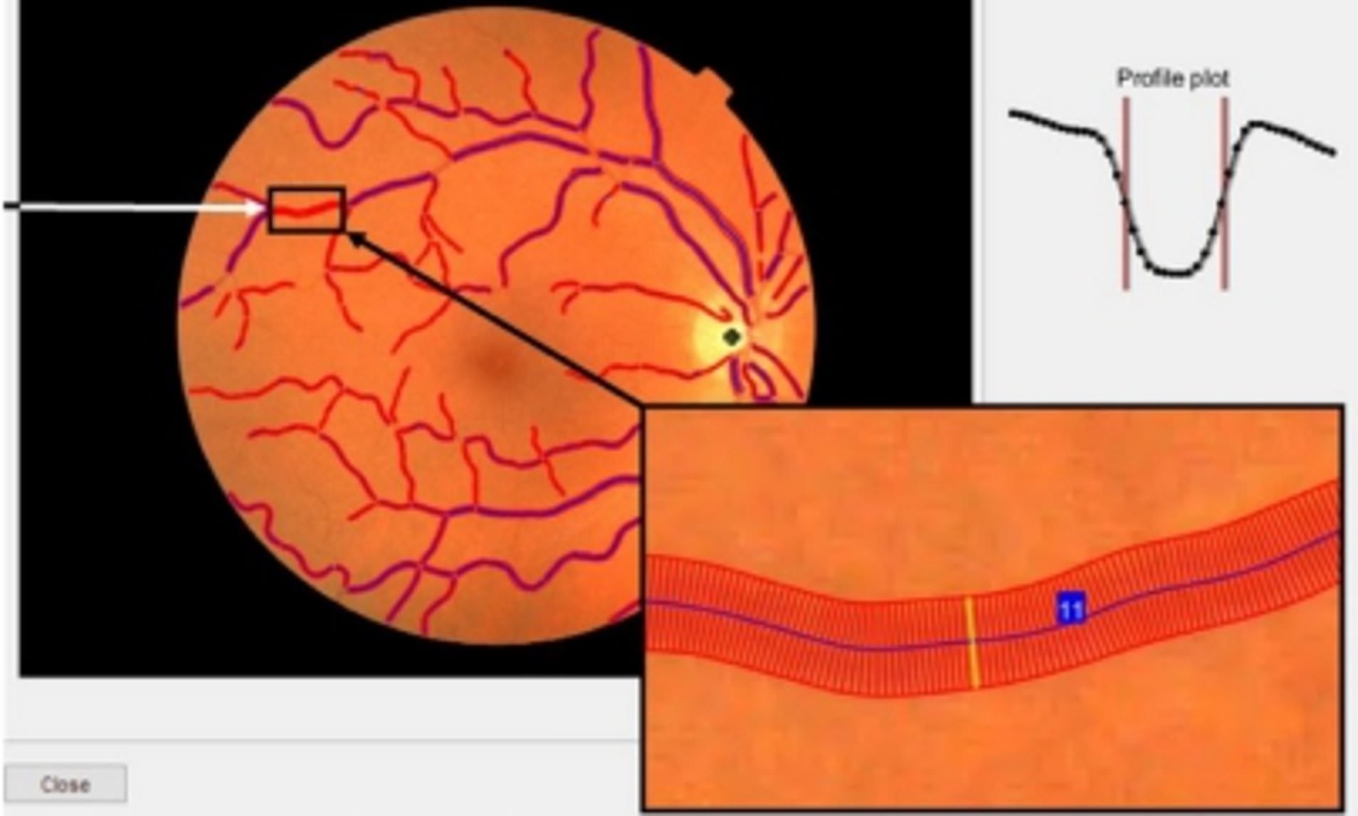 IA retina